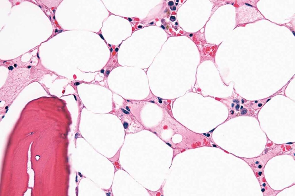 What Is Aplastic Anemia: Key Causes & Treatment