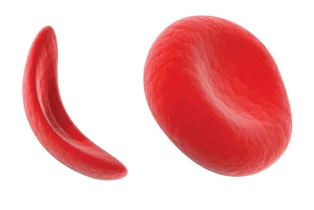 Aplastic Crisis In Sickle Cell Anemia: Crucial Guide